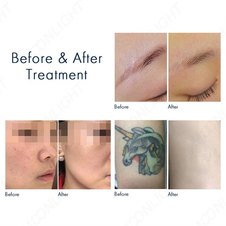 Diode Laser Hair Removal Machine 2 in 1